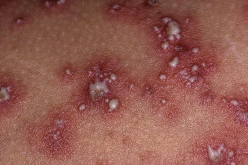 Se aprueba en México terapia que mejorará la vida de pacientes con Psoriasis Pustulosa Generalizada, enfermedad rara y mortal