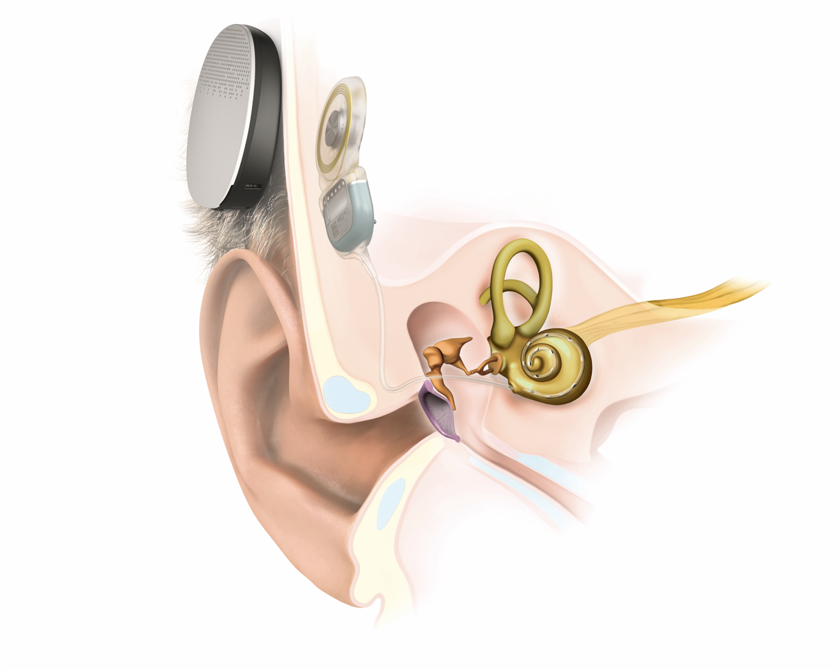 Implantes cocleares: una oportunidad para conectar con el sonido