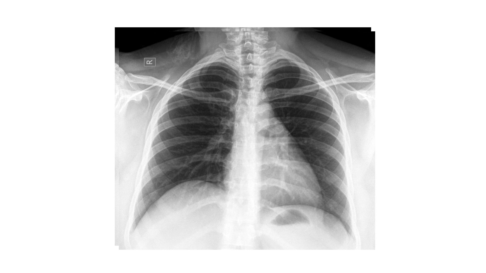 FDA aprueba primera terapia dirigida para cáncer de pulmón de células no pequeñas avanzado con mutación HER2 como tratamiento inicial