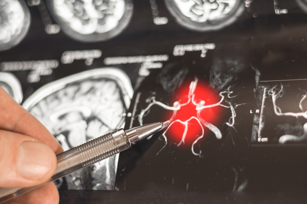 Cirugía y neuroestimulación logran controlar la epilepsia en el 80% de los casos difíciles